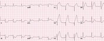 V2,V3,V4导联ST段抬高代表什么？