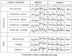 V2,V3,V4导联ST段抬高代表什么？